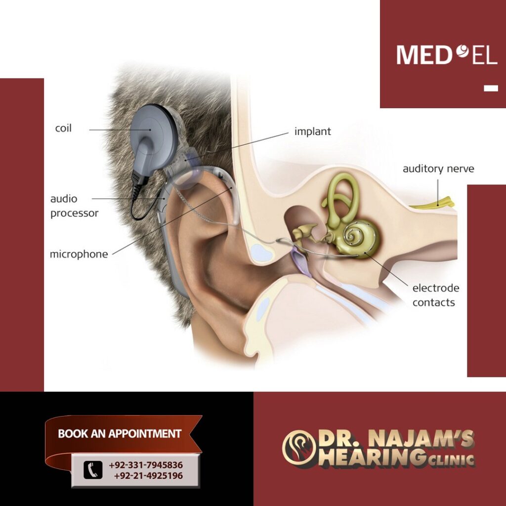 cochlear implant price in Pakistan